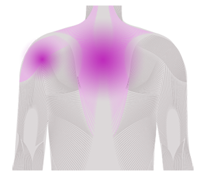 Idiopathic inflammatory myopathies or myositis
