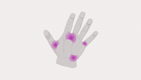 Systemic sclerosis / Scleroderma